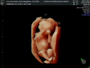 Ultrasonido del Feto: 4a Dimensión