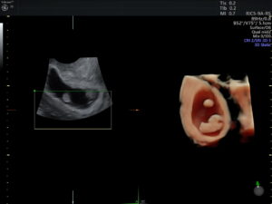 Ultrasonido del Feto: 4a Dimensión