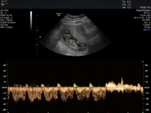 Ultrasonido del Feto: 4a Dimensión
