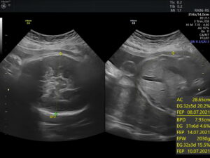 Ultrasonido del Feto