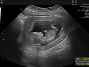 Ultrasonido del Feto
