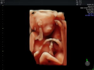 Ultrasonido del Feto: 4a Dimensión