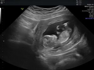 Ultrasonido del Feto