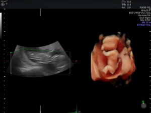 Ultrasonido del Feto: 4a Dimensión