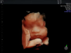 Ultrasonido del Feto: 4a Dimensión