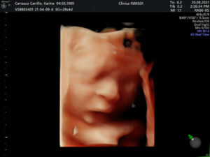 Ultrasonido del Feto: 4a Dimensión