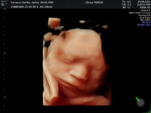 Ultrasonido del Feto: 4a Dimensión