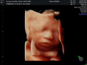 Ultrasonido del Feto: 4a Dimensión