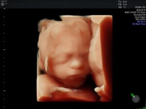 Ultrasonido del Feto: 4a Dimensión
