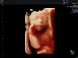 Ultrasonido del Feto: 4a Dimensión