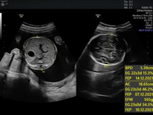 Ultrasonido del Feto