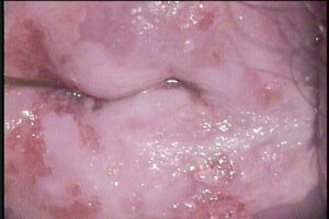 Colposcopía Papiloma