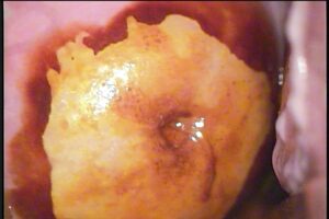 Colposcopía Papiloma