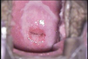 Colposcopía Papiloma