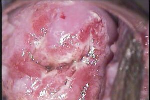 Colposcopía Cancer: ANTES