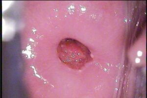 Colposcopía Cancer: DESPUES